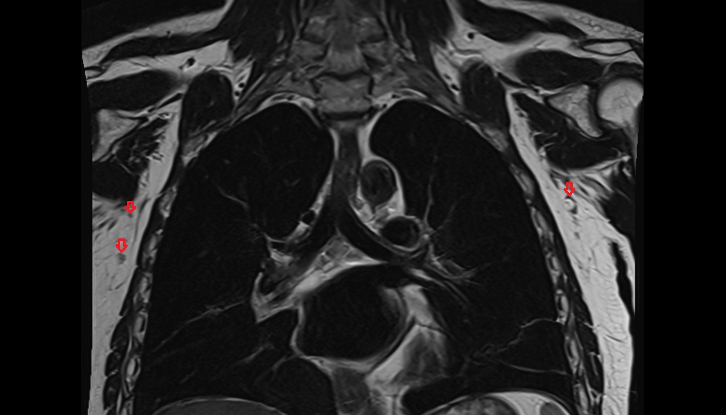 axillary lymph nodes  anatomy MRI CORONAL image -img-00000-00000