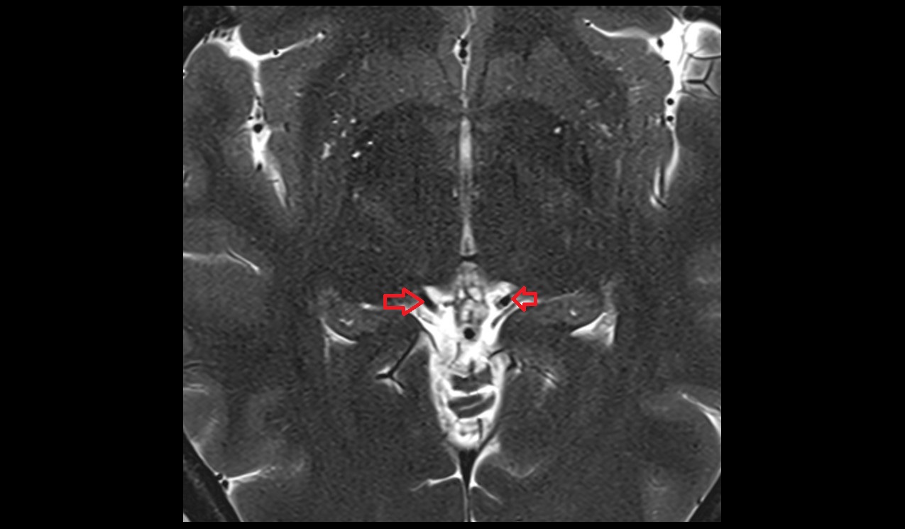 basal vein of rosenthal MRI 3T axial image 1