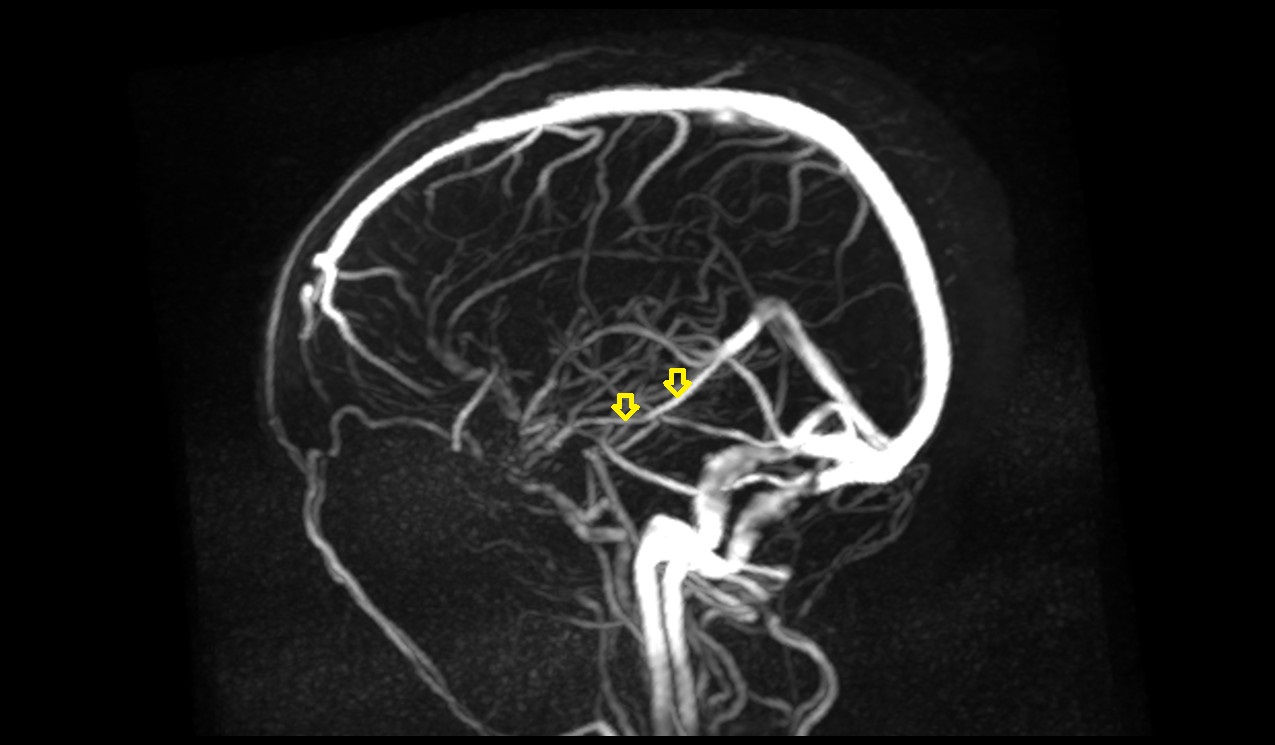 basal vein of rosenthal MRI 3T mip image