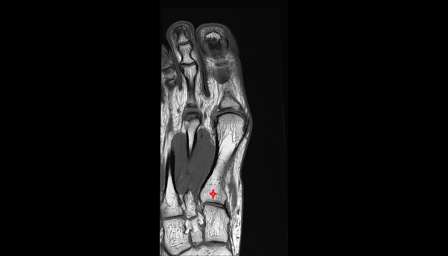 base of metatarsal bone  coronal cross sectional anatomy 3T MRI AI enhanced radiology image-img-00000-00000