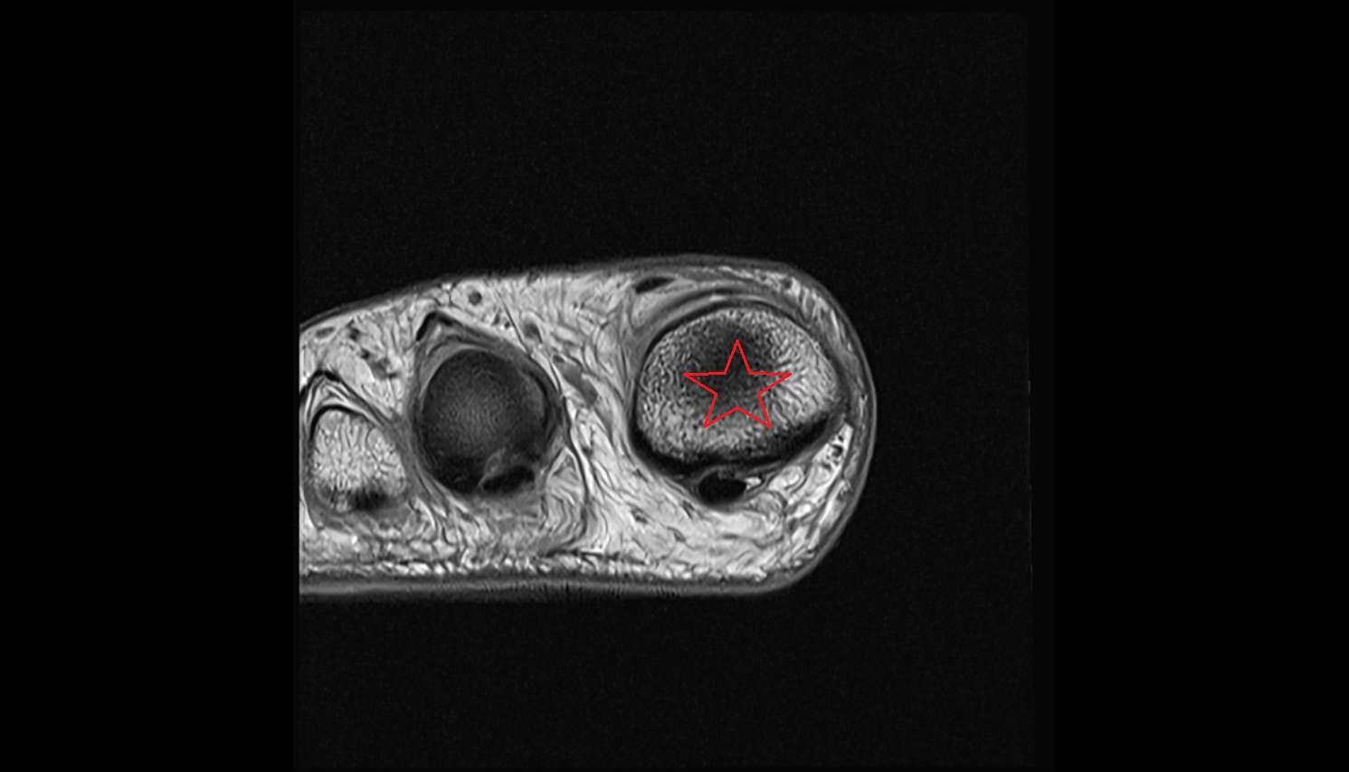base  of phalanx of foot coronal cross sectional anatomy 3T MRI AI enhanced radiology image-img-00000-00000