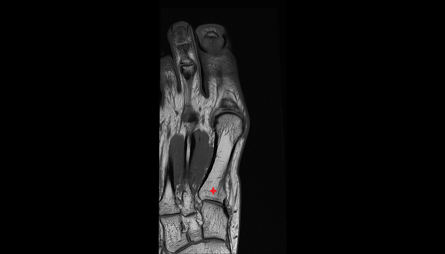 base of the metatarsal bone  coronal cross sectional anatomy 3T MRI AI enhanced radiology image-img-00000-00000