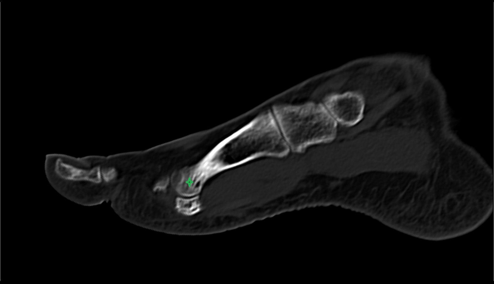 base of the metatarsal bone ct image