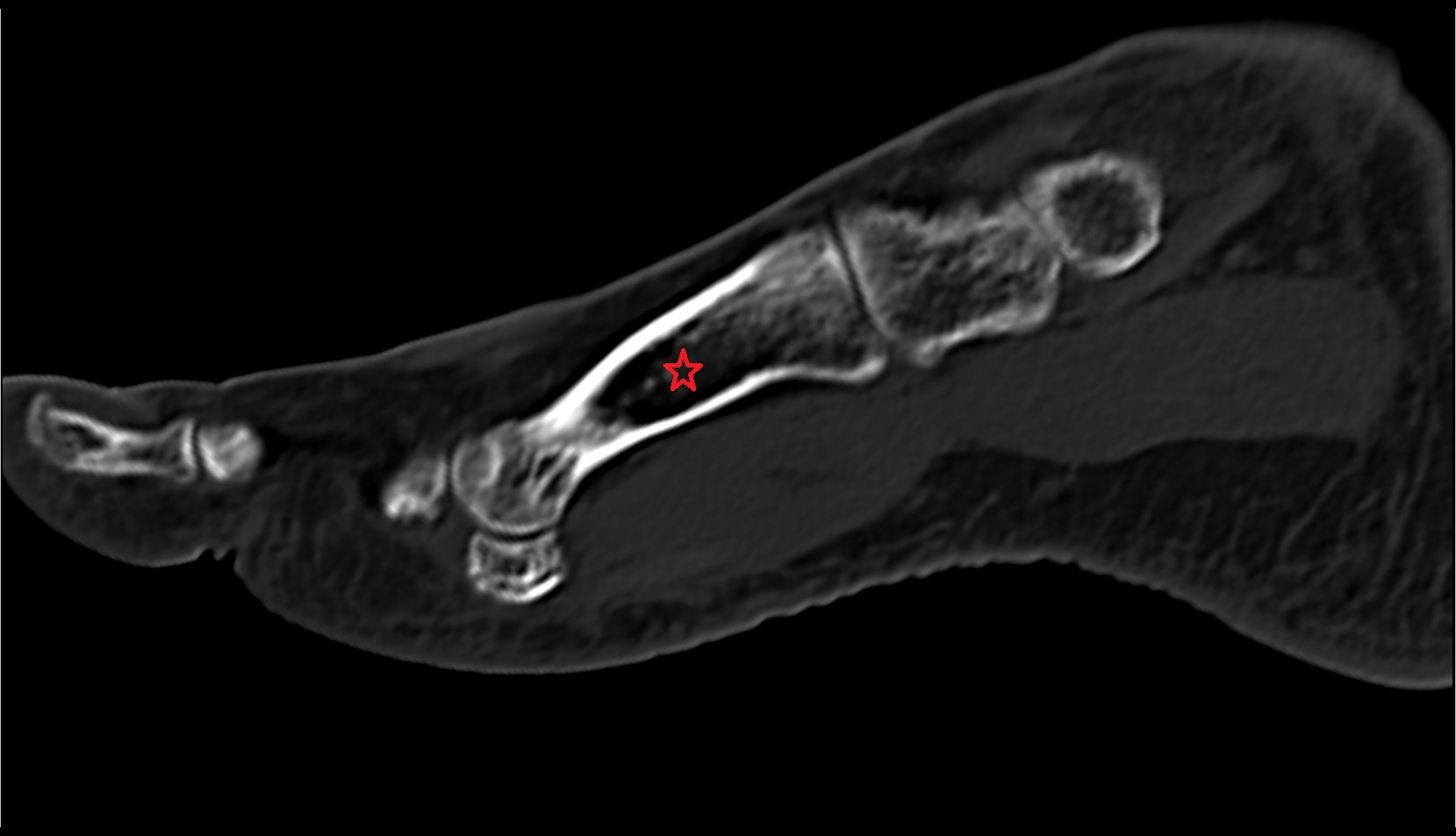body of metatarsal bone sagittal ct image