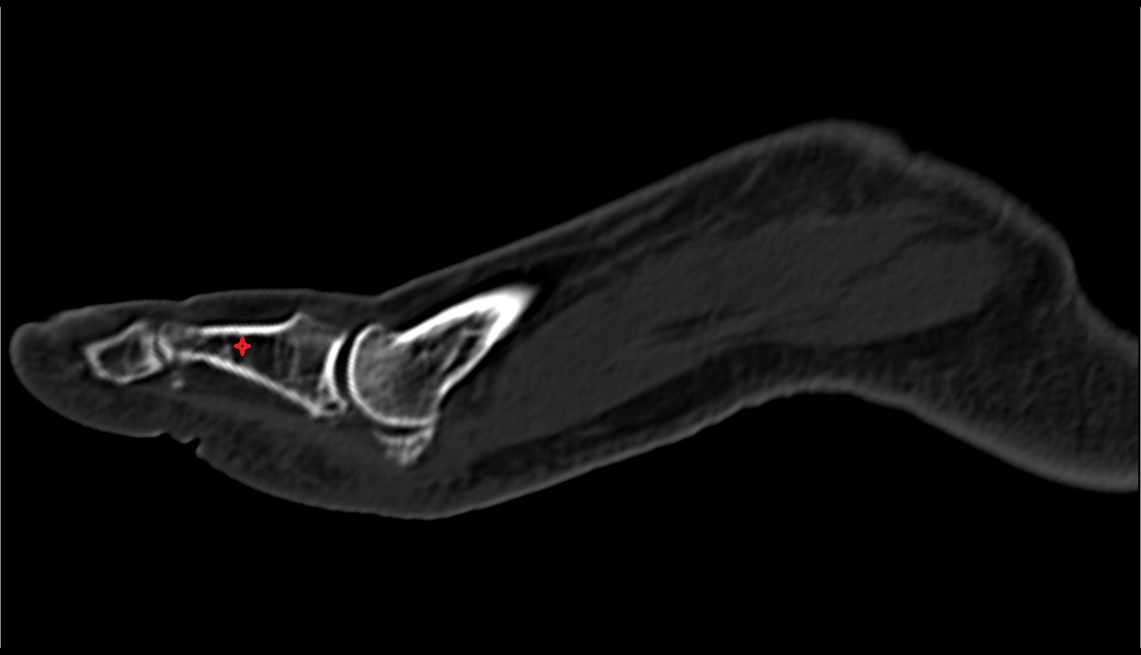 body  of phalanx of foot sag ct image