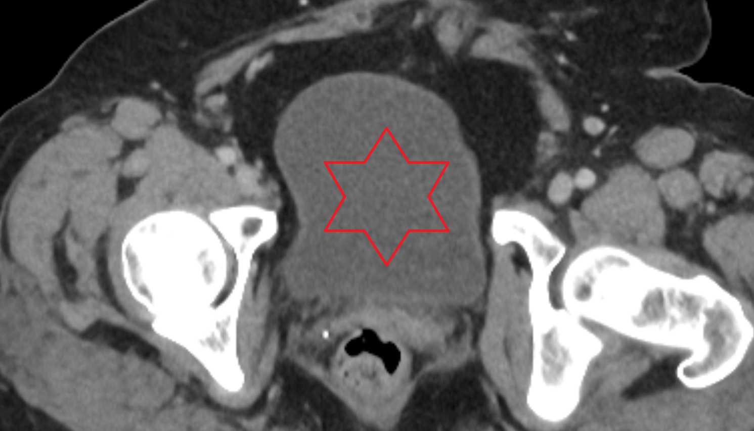 body   of urinary bladder  ct  axial  anatomy  image-img-00000-00000