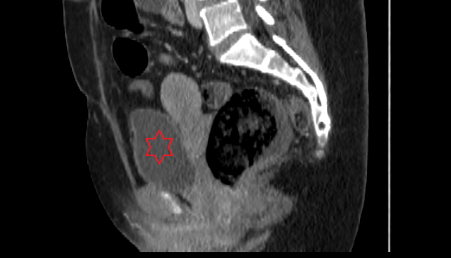 body  of urinary bladder  ct sagittal  anatomy  image-img-00000-00000