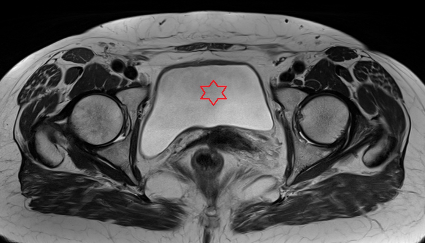body of urinary bladder  mri axial anatomy  image-img-00000-00000