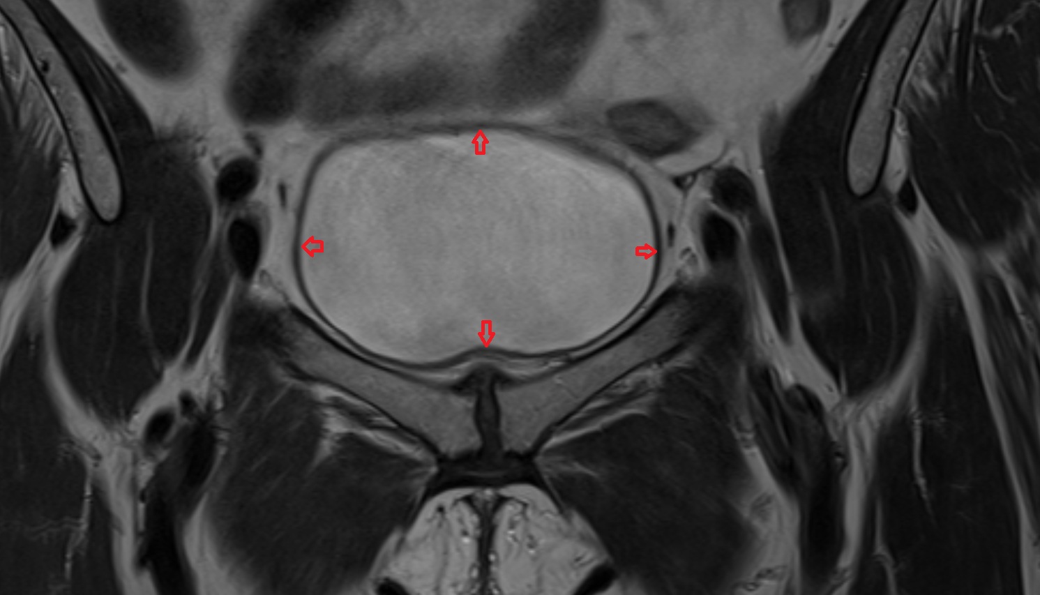 body  of urinary bladder  mri coronal  anatomy  image-img-00000-00000