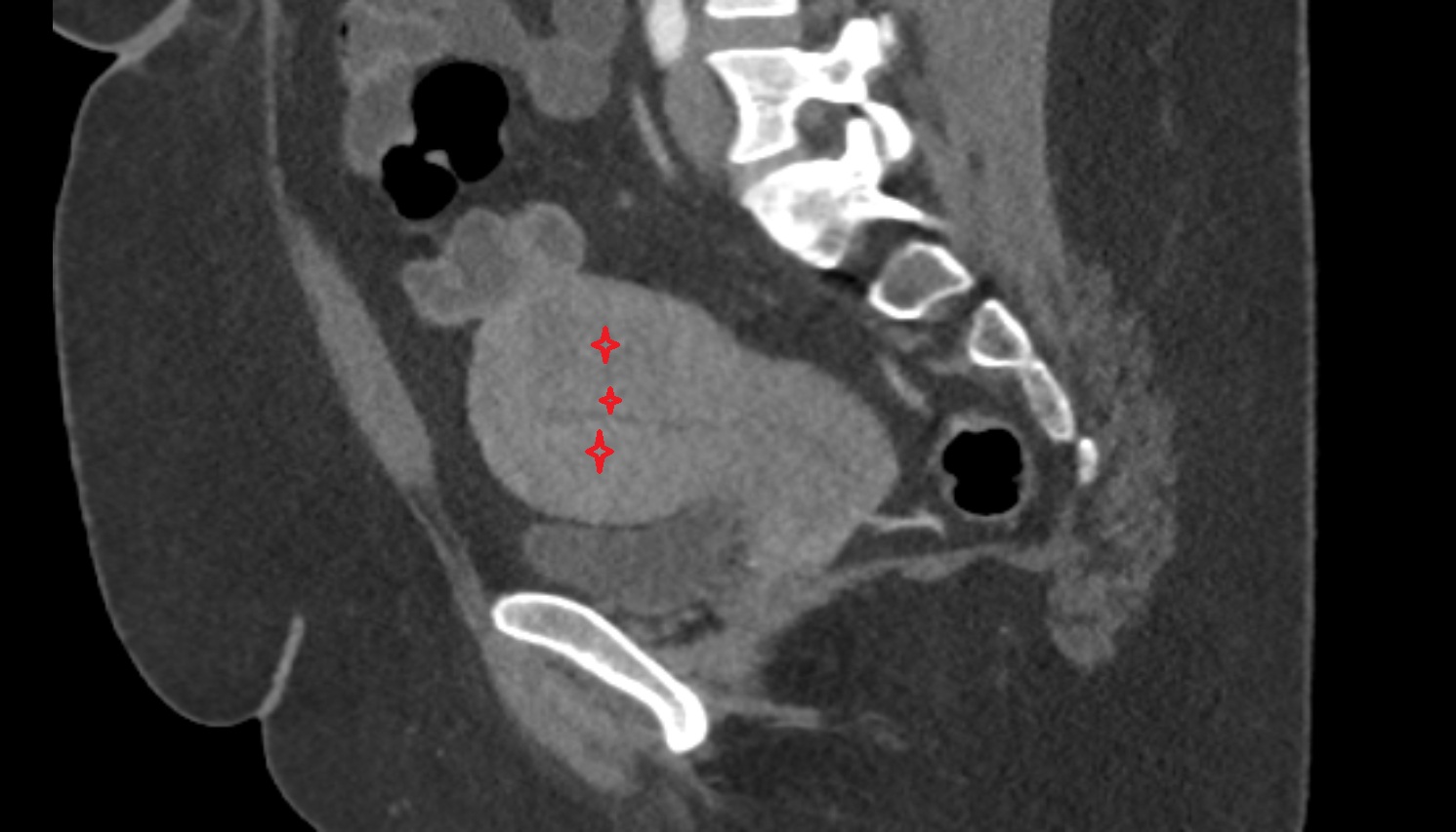 body of uterus CT sagittal  image anatomy  image-img-00000-00000