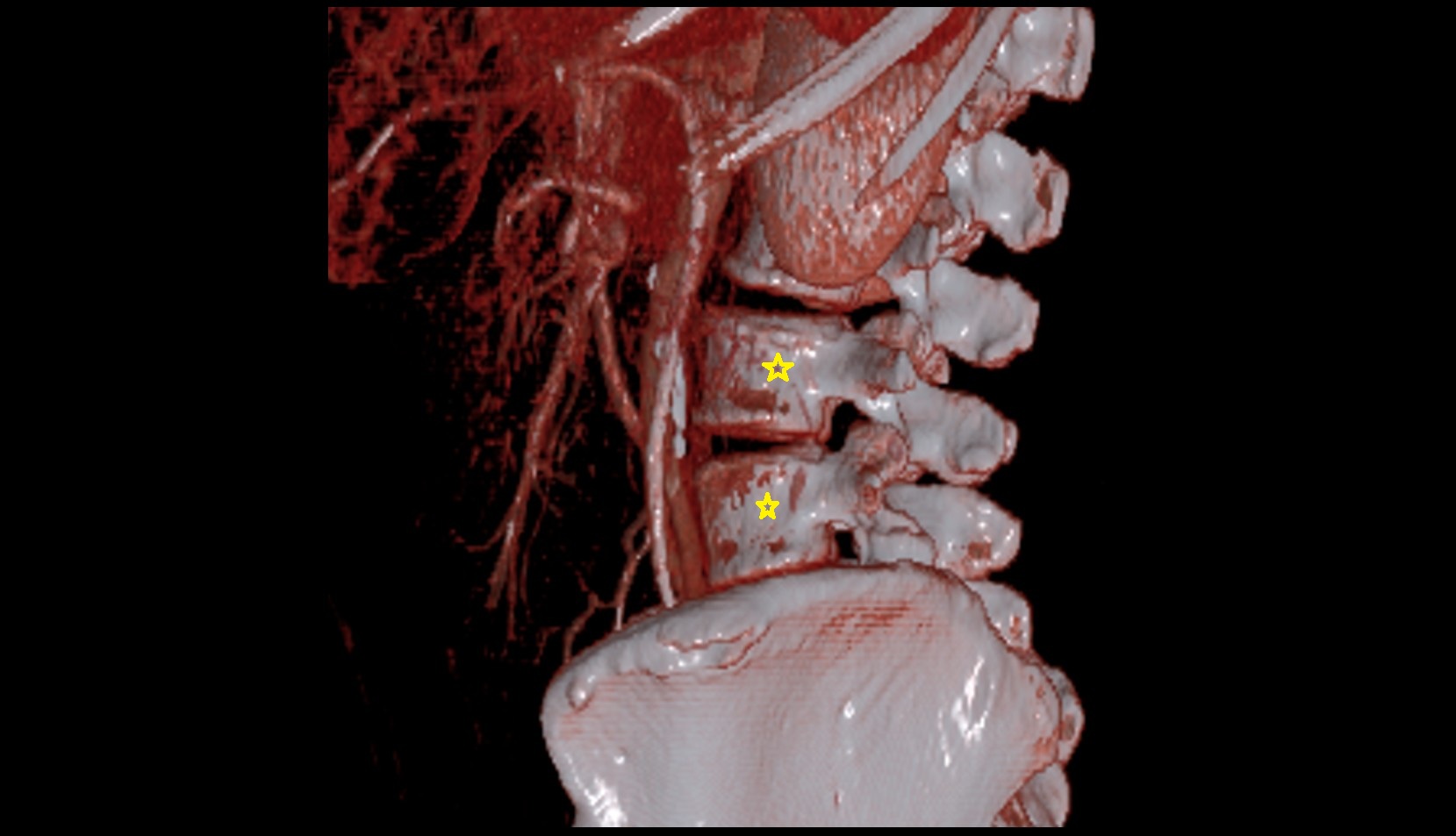 body of vertebrae 3D IMAGE