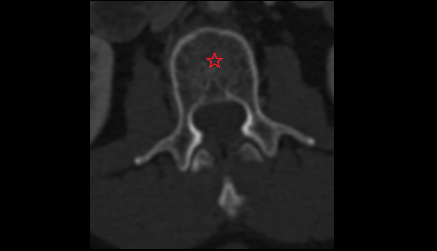 body of vertebrae CT axial image