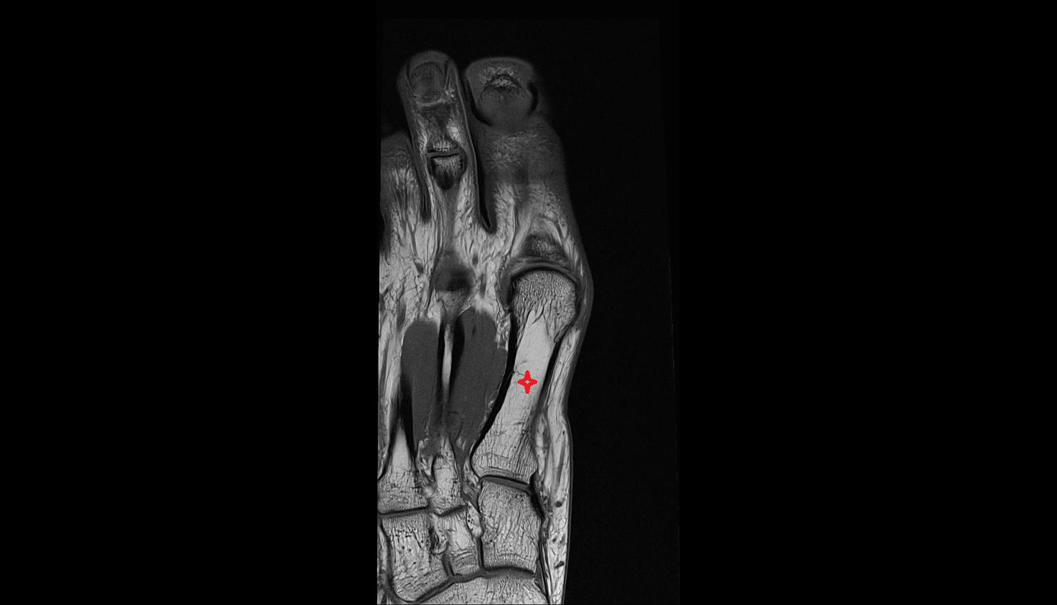 body (shaft) of the metatarsal bone  coronal cross sectional anatomy 3T MRI AI enhanced radiology image-img-00000-00000