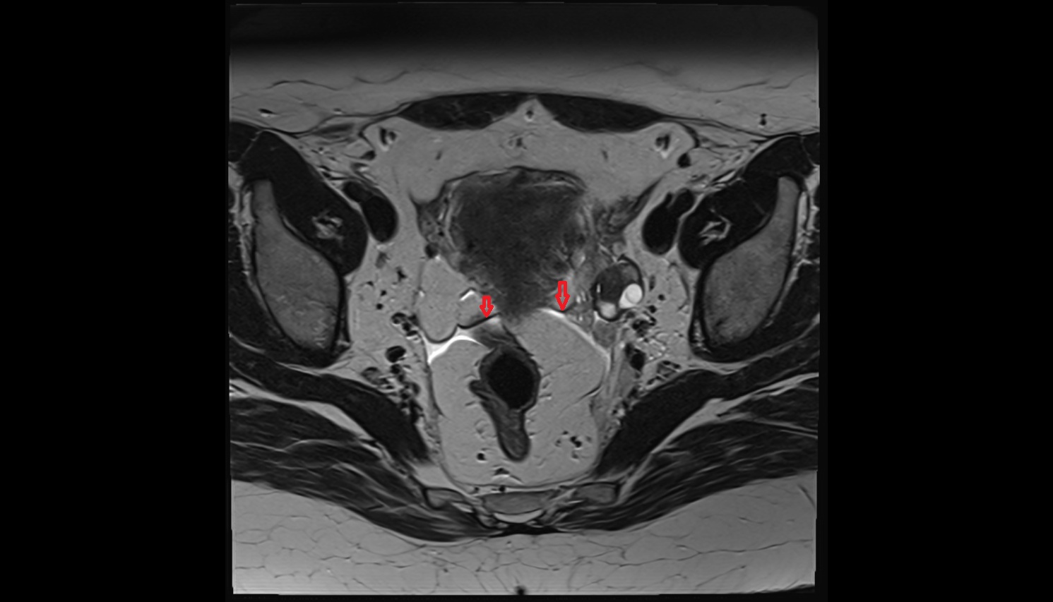 broad ligament of uterus mri axial image  image anatomy  image-img-00000-00000