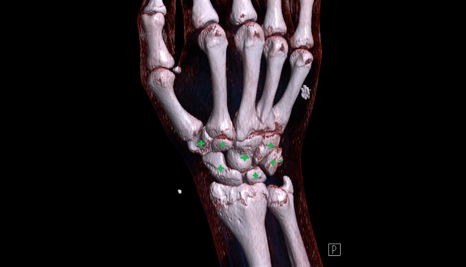 carpal bones CT 3D VRT image