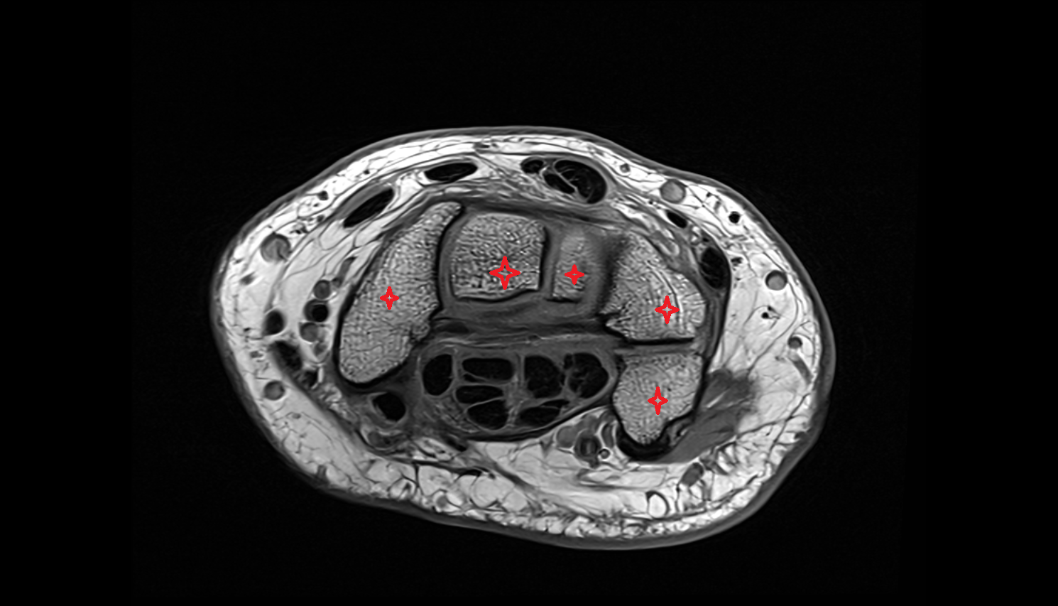 carpal bones axial cross sectional anatomy 3T MRI AI enhanced radiology image-img-00000-00000
