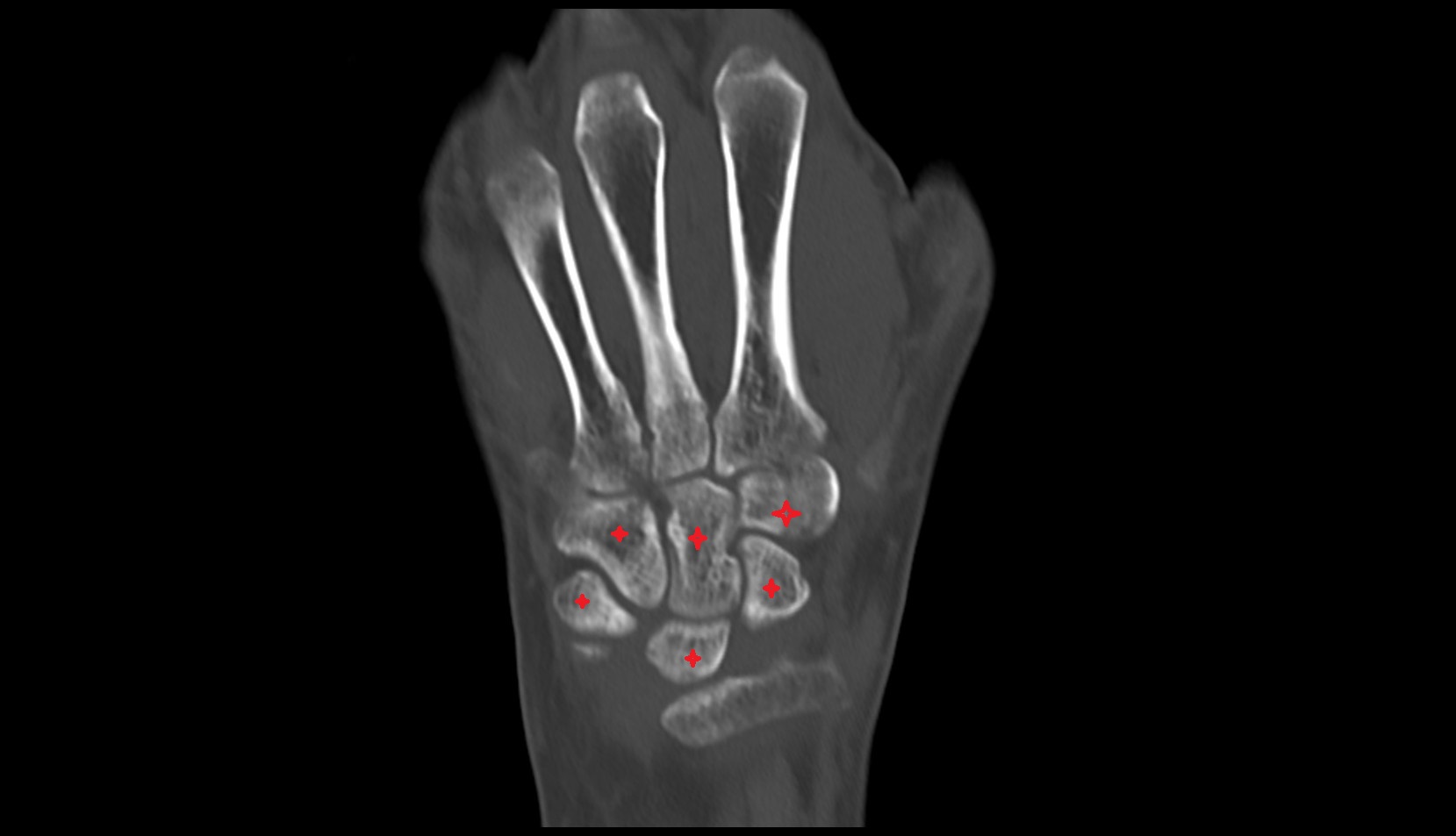 carpal bones ct coronl image