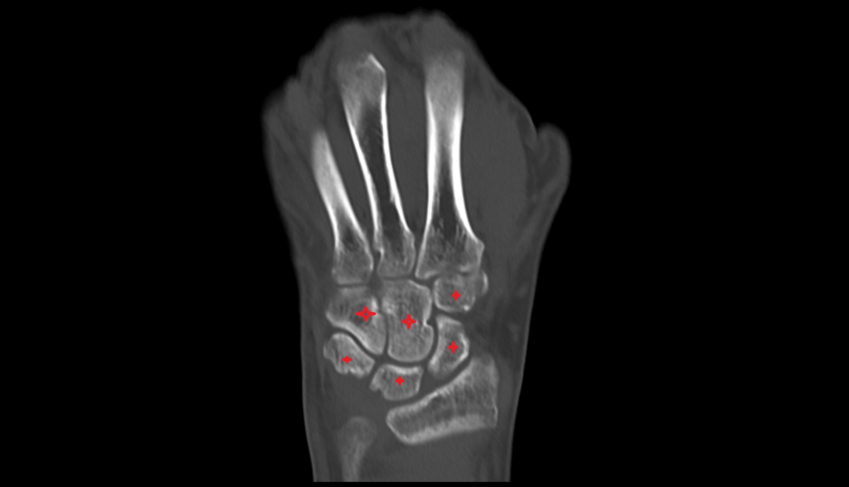 carpal bones ct coronl image 1
