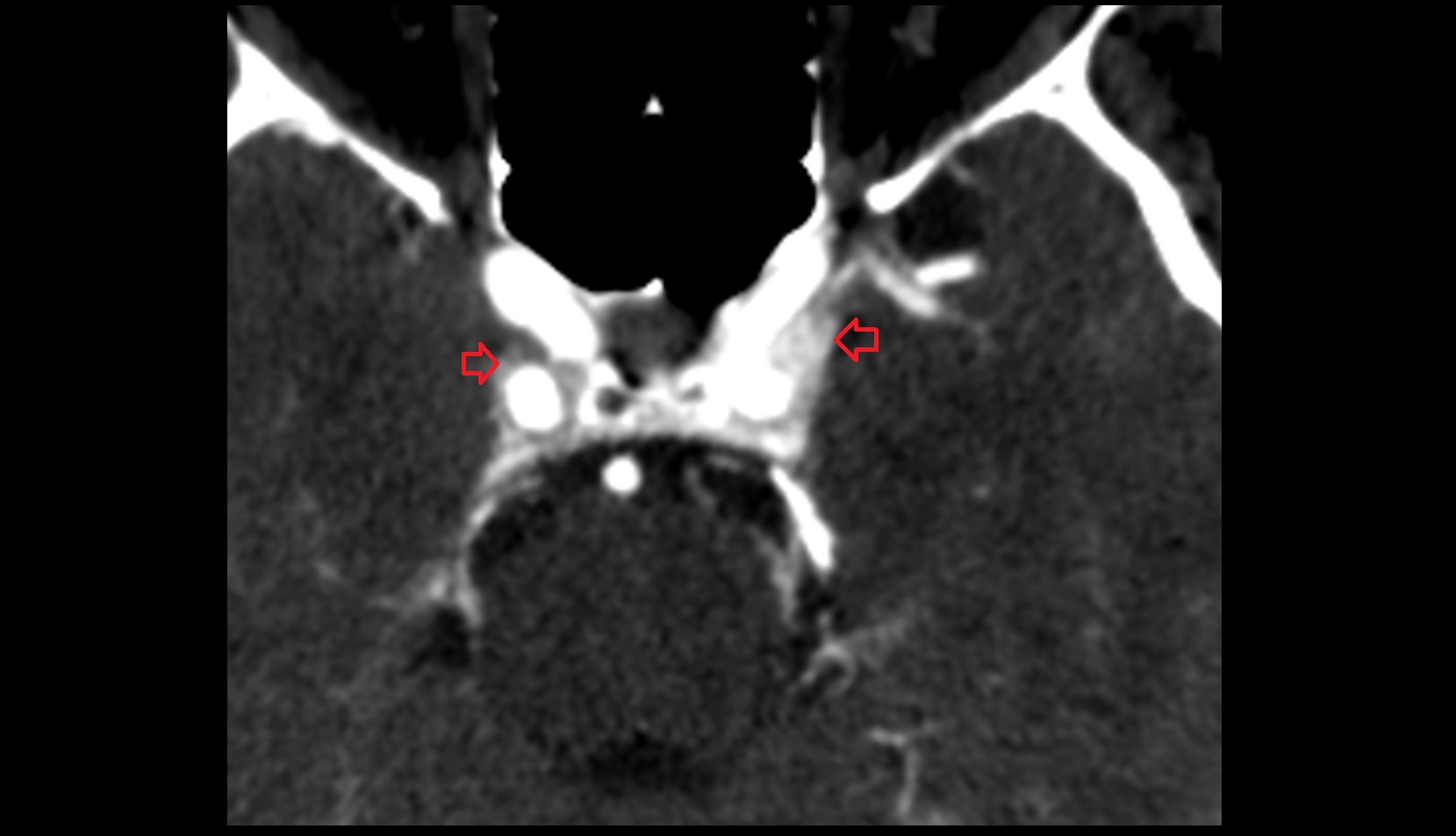 cavernous sinus CT