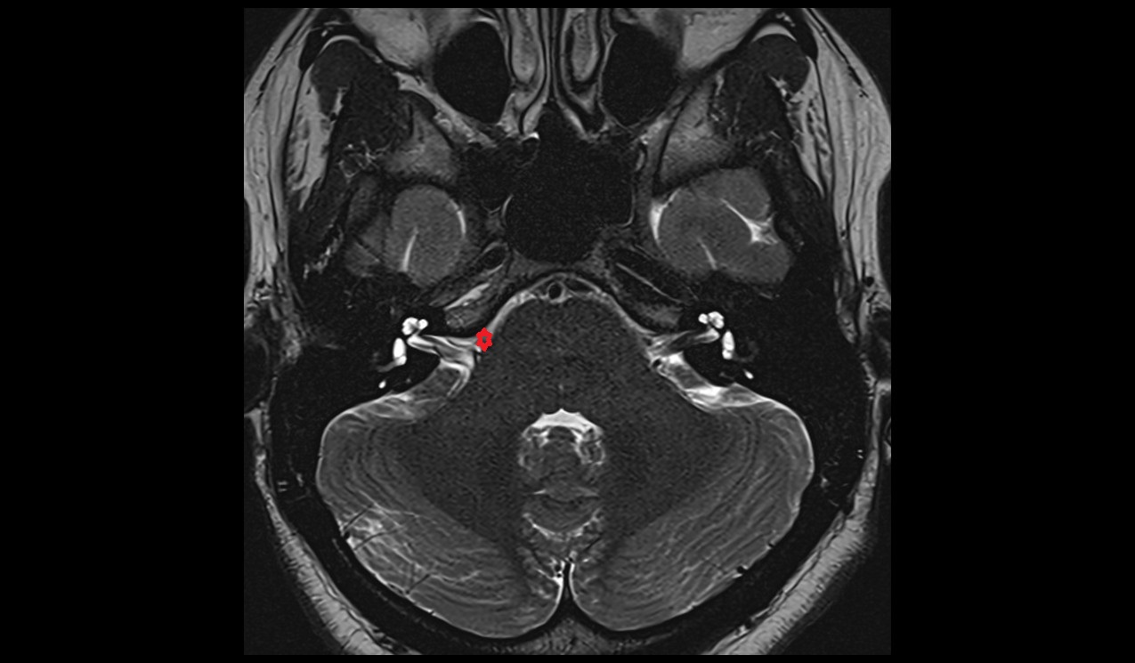 cerebellopontine angle MRI 3T axial image