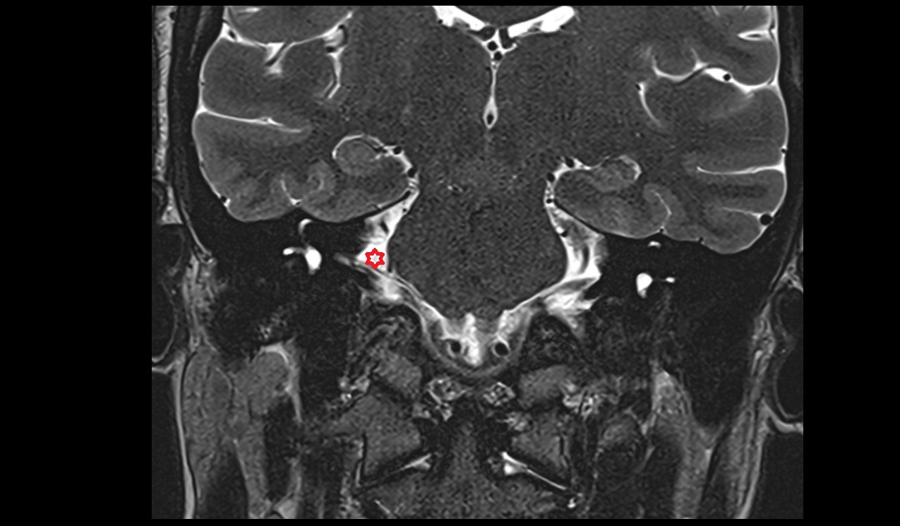 cerebellopontine angle MRI 3T  coronal  image