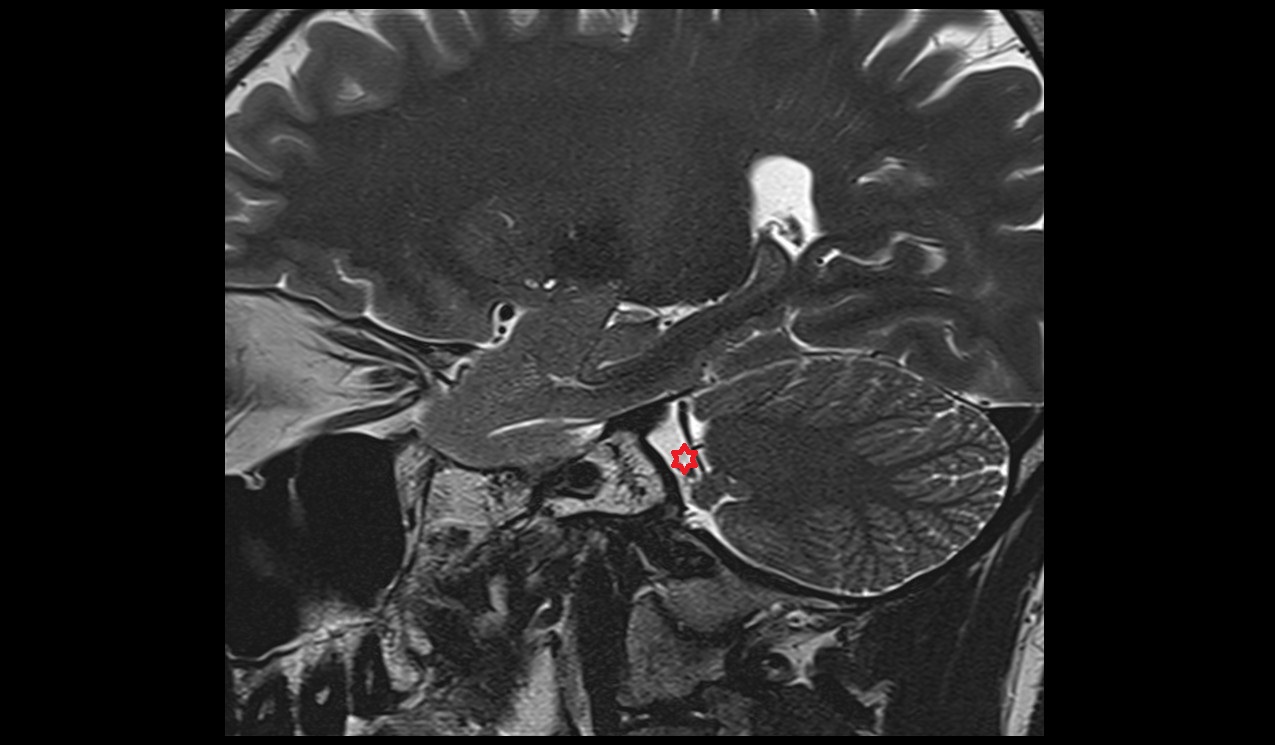 cerebellopontine angle MRI 3T sagittal  image