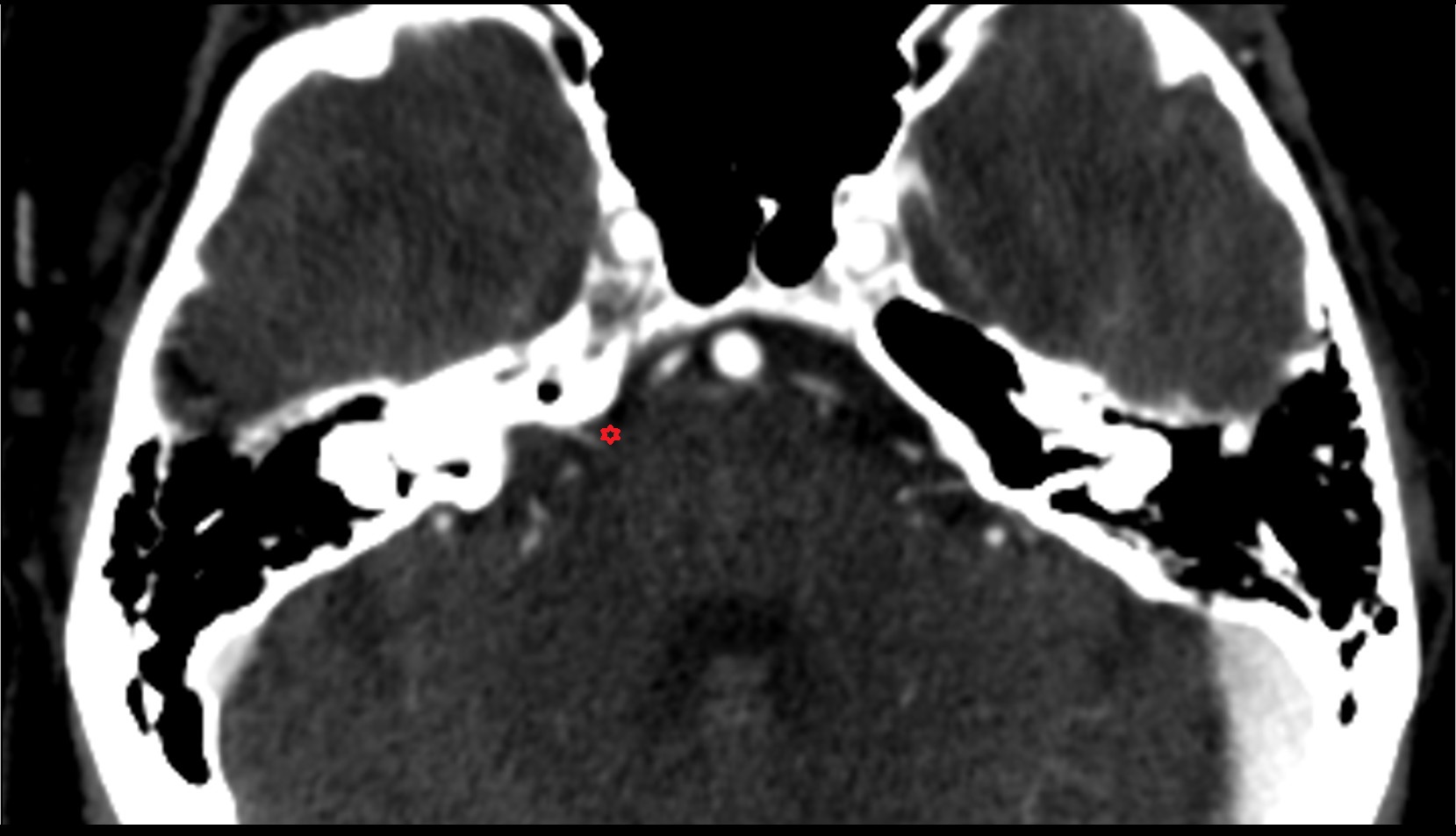 cerebellopontine angle ct  image