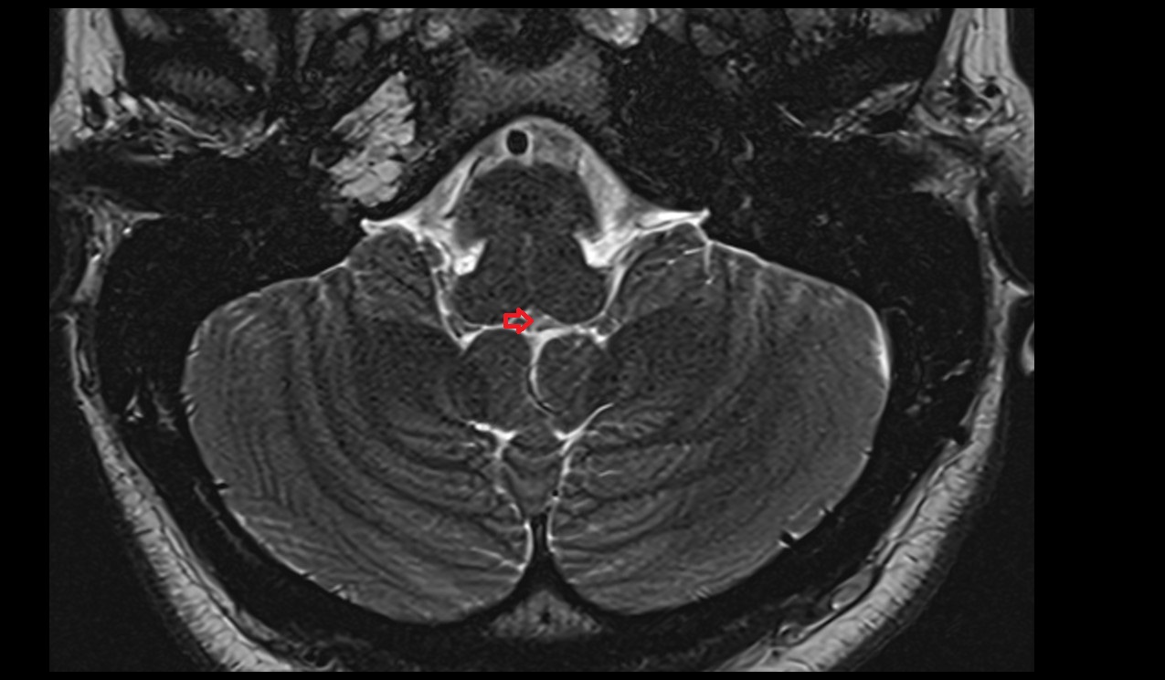 choroid plexus of fourth ventricle  mri 3t axial image
