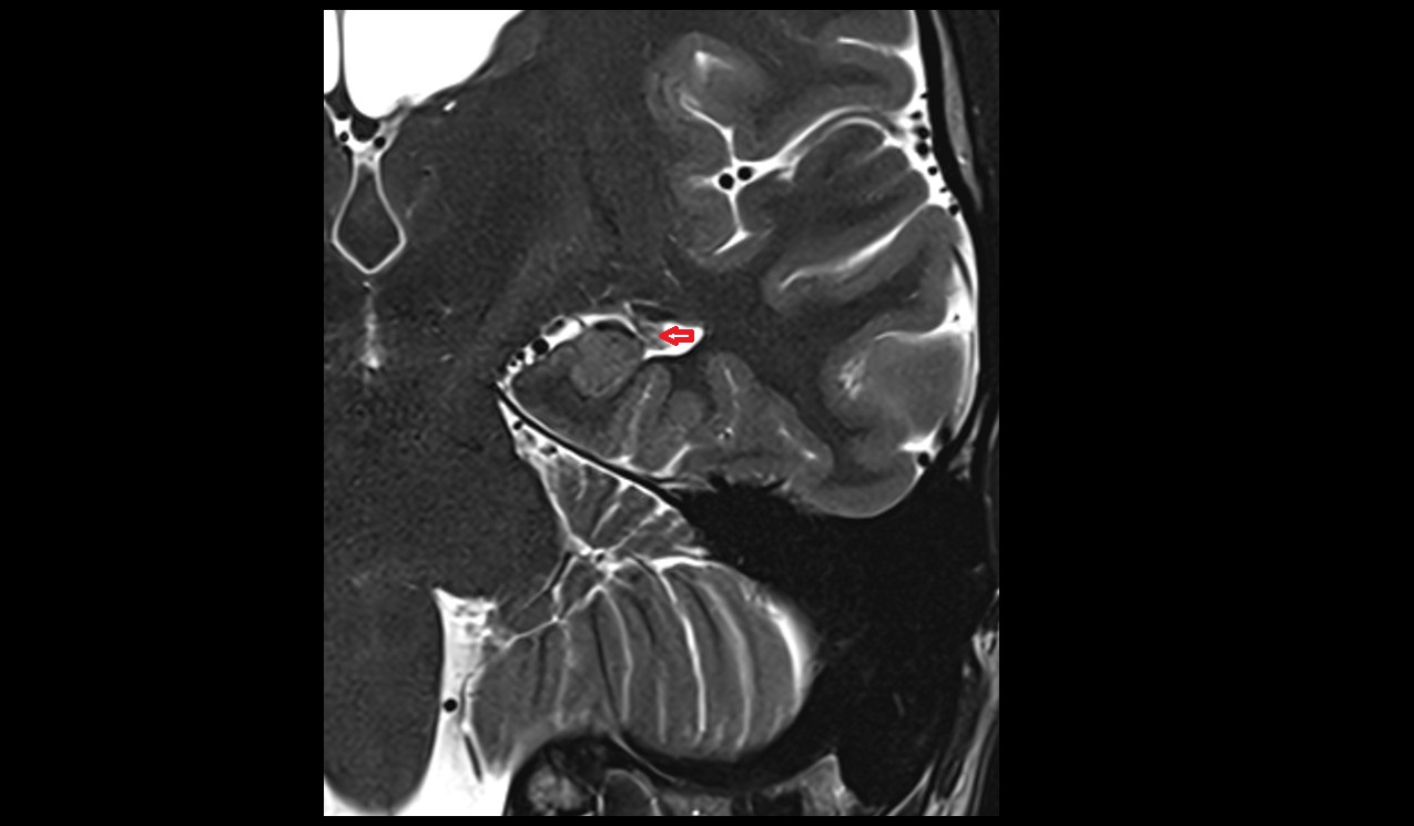 choroid plexus of lateral ventricle hippocampus area coronal 3t image