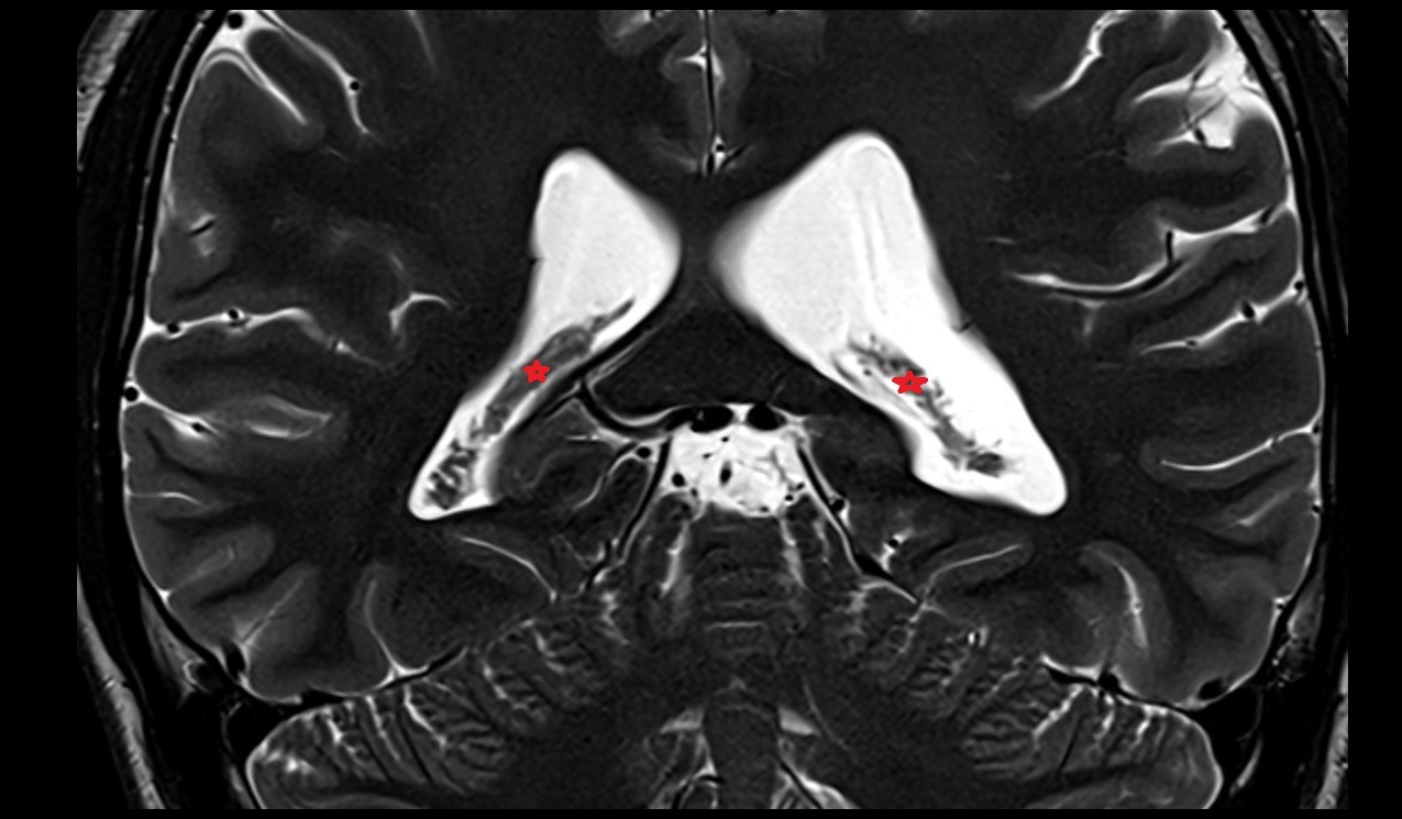 choroid plexus of lateral ventricle  mri 3t coronal image