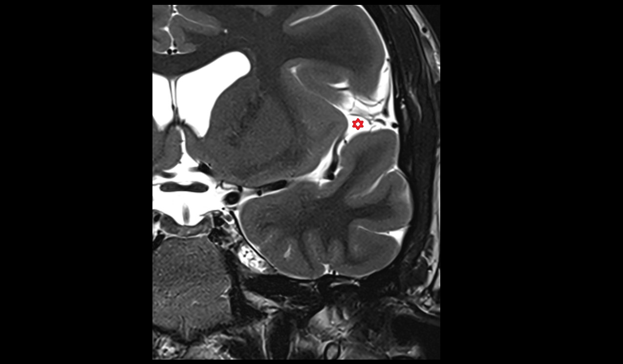 cistern of lateral cerebral fossa (Sylvian cistern) mri 3t coronal image