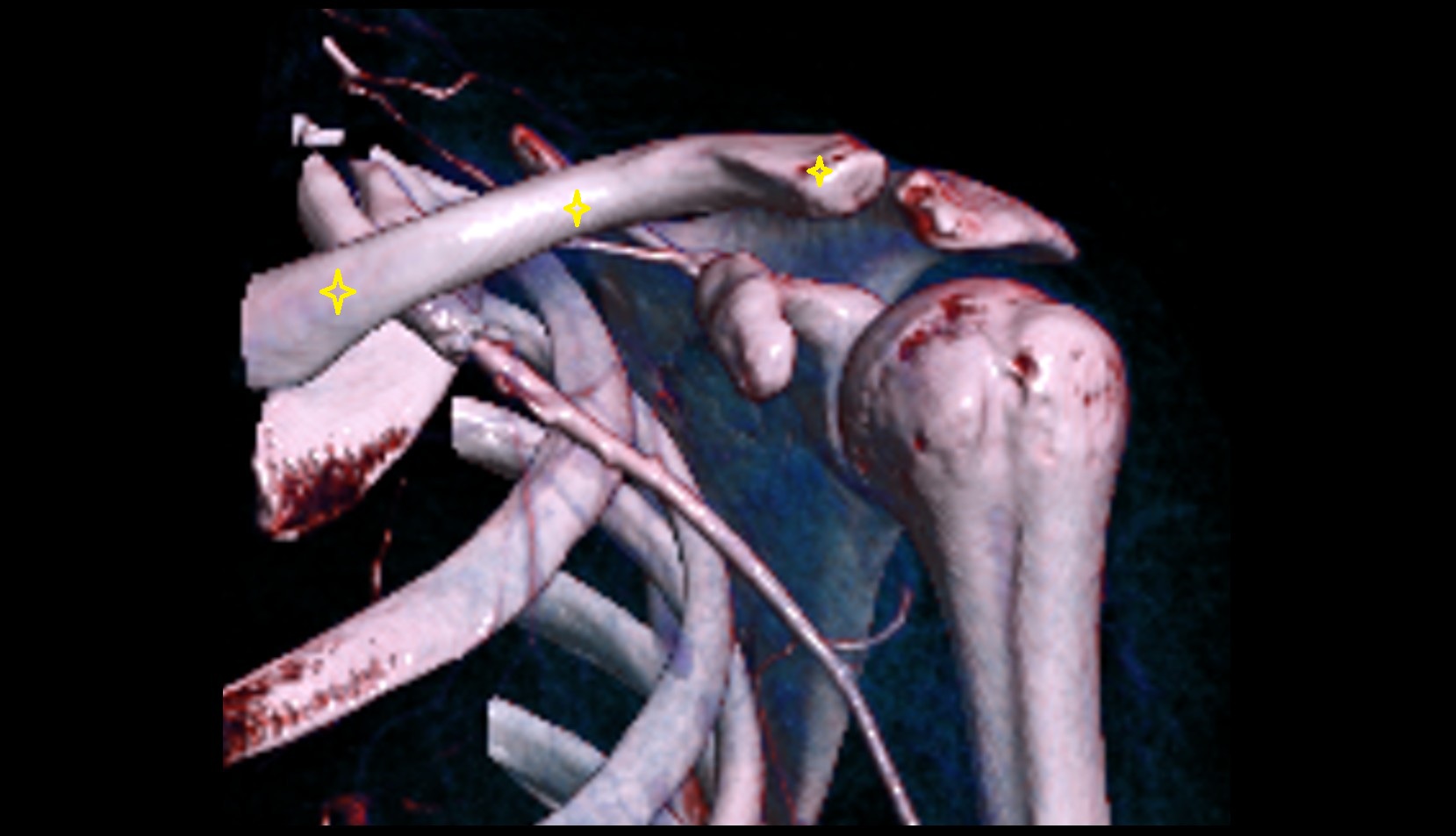 clavicle 3d vrt image