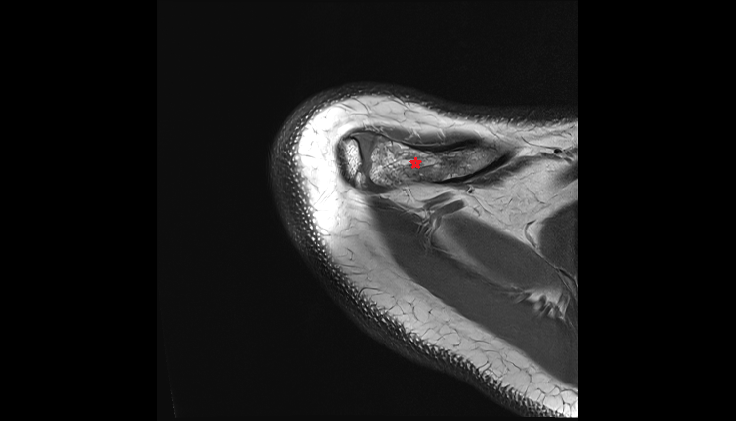clavicle axial cross sectional anatomy 3T MRI AI enhanced radiology image -img-00000-00000