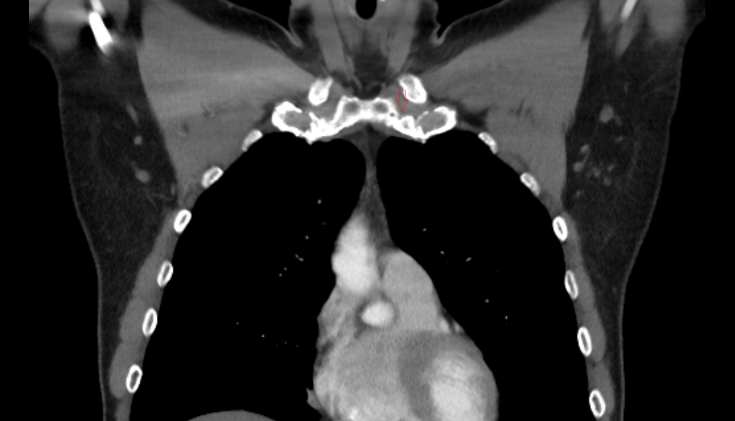 clavicular notch coronal CT  image-img-00000-00000