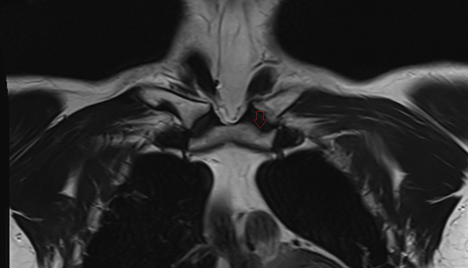 clavicular notch coronal MRI  image-img-00000-00000