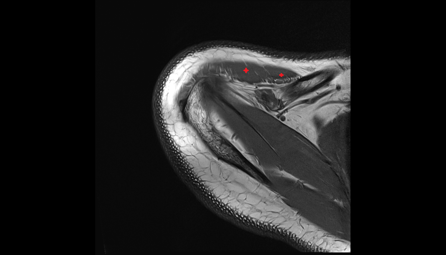 clavicular part of deltoid muscle  AXIAL cross sectional anatomy 3T MRI AI enhanced radiology image-img-00000-00000