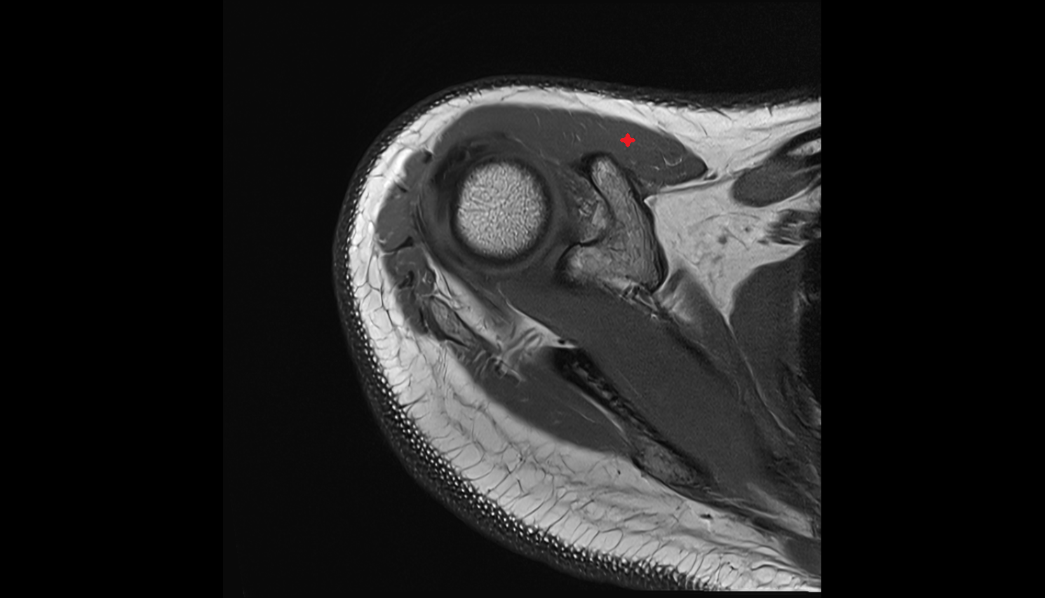 clavicular part of deltoid muscle  AXIAL cross sectional anatomy 3T MRI AI enhanced radiology image-img-00000-00000_00001