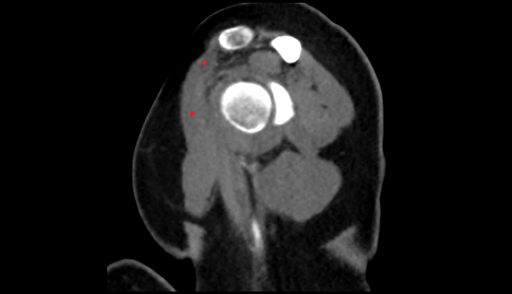 clavicular part of deltoid muscle CT SAG image