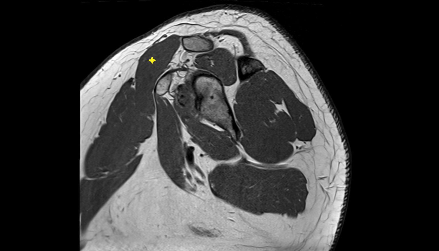 clavicular part of deltoid muscle  sagittal cross sectional anatomy 3T MRI AI enhanced radiology image-img-00000-00000
