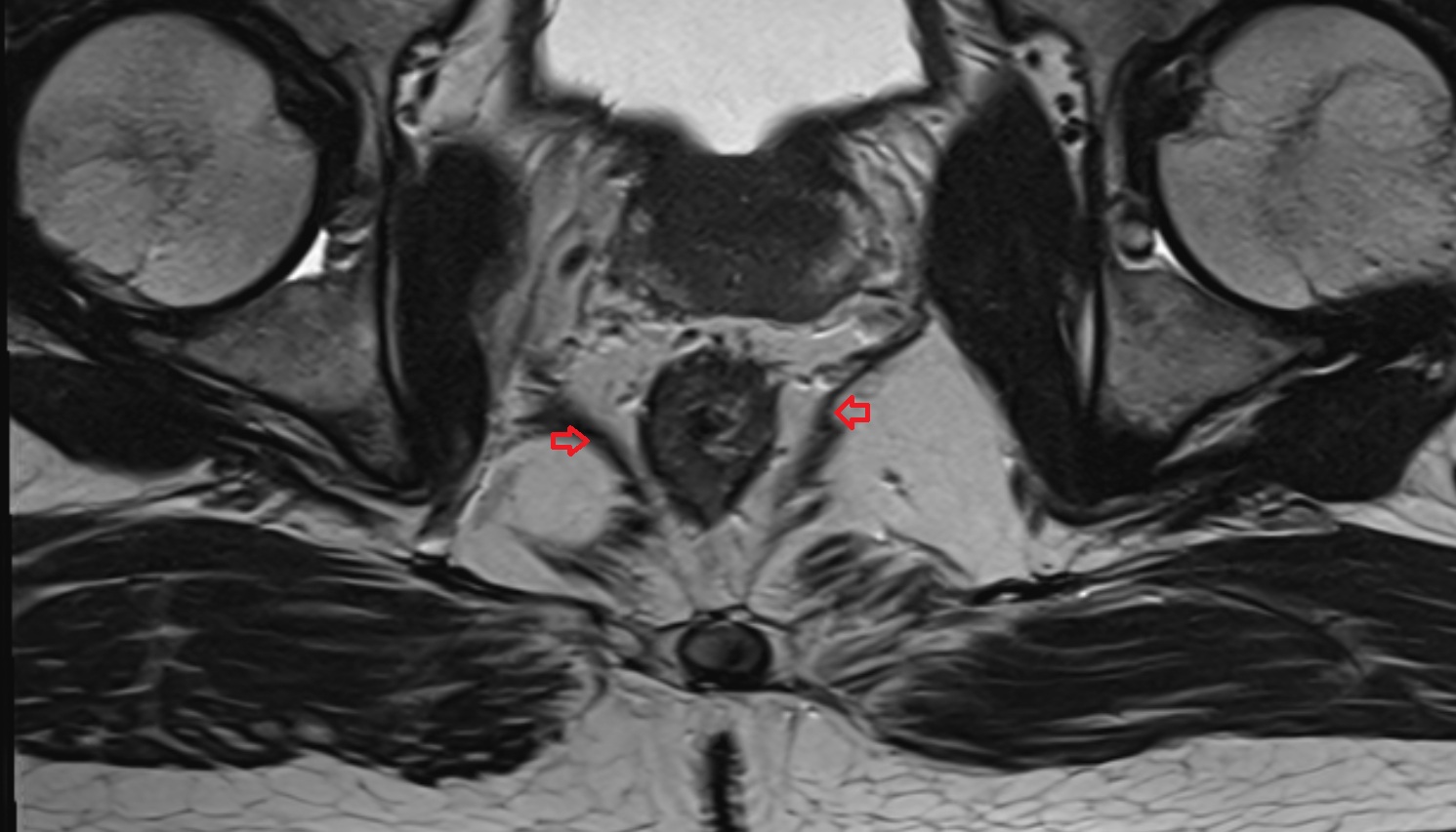 coccygeus muscle  MRI  axial  anatomy  image-img-00000-00000
