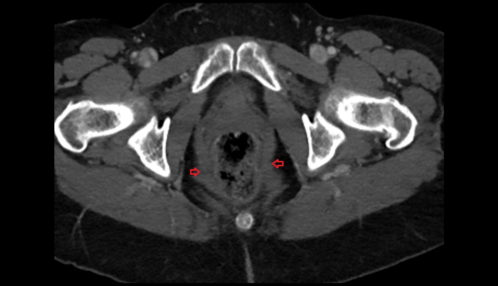coccygeus muscle ct axial image