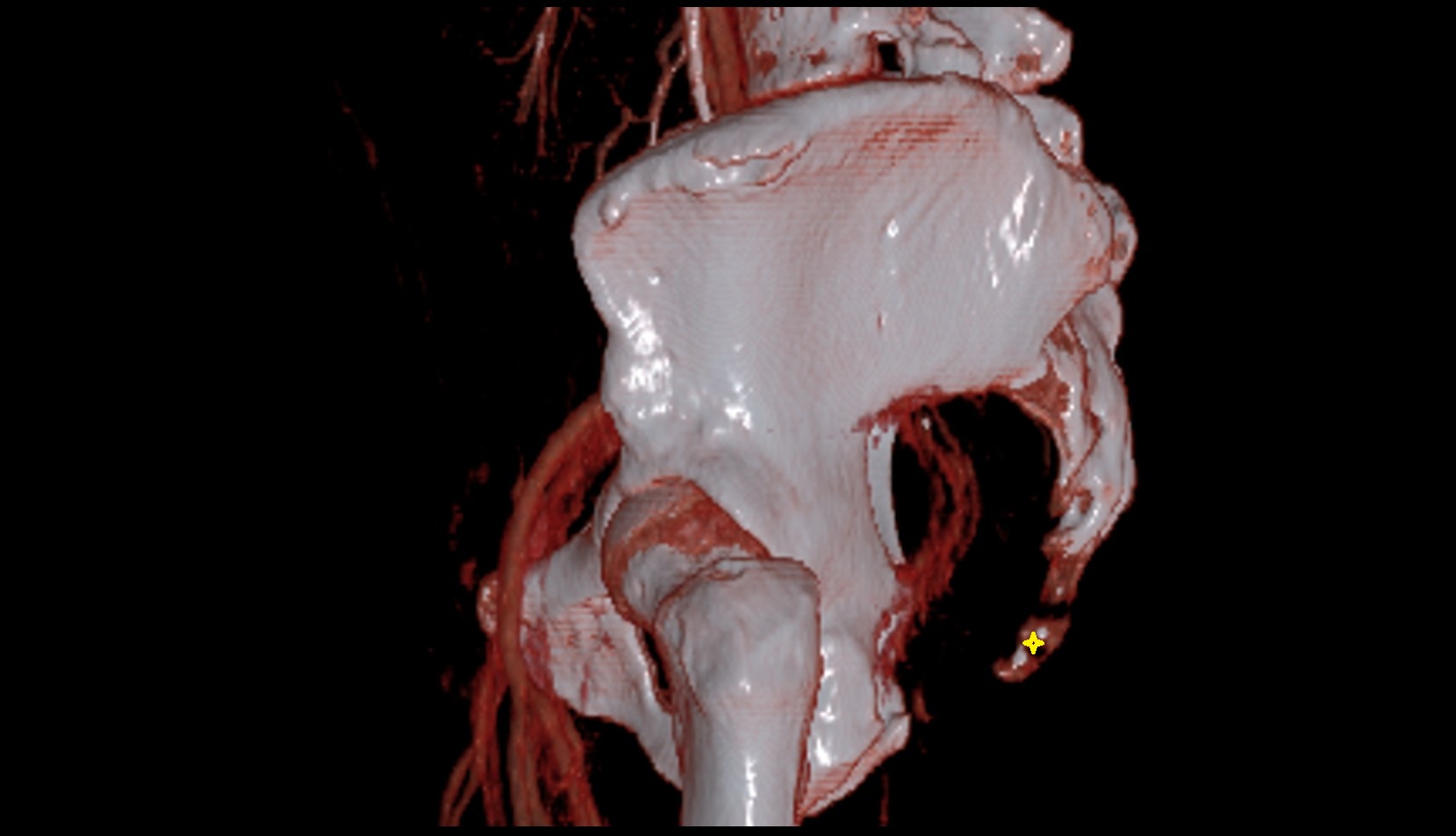 coccyx  CT VRT 3D image