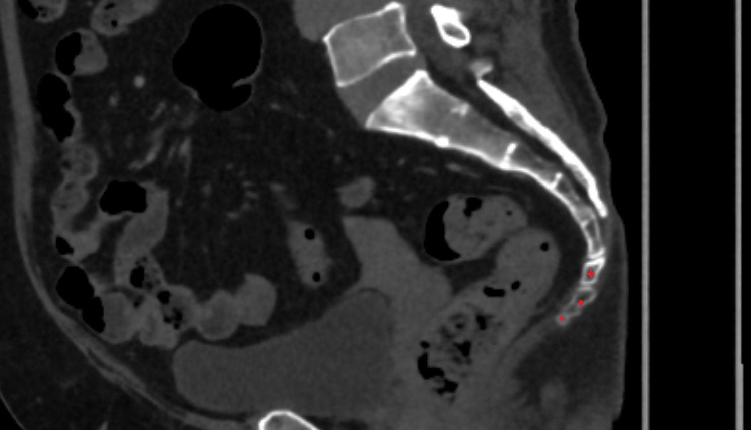 coccyx  CT sagittal anatomy  image -img-00000-00000
