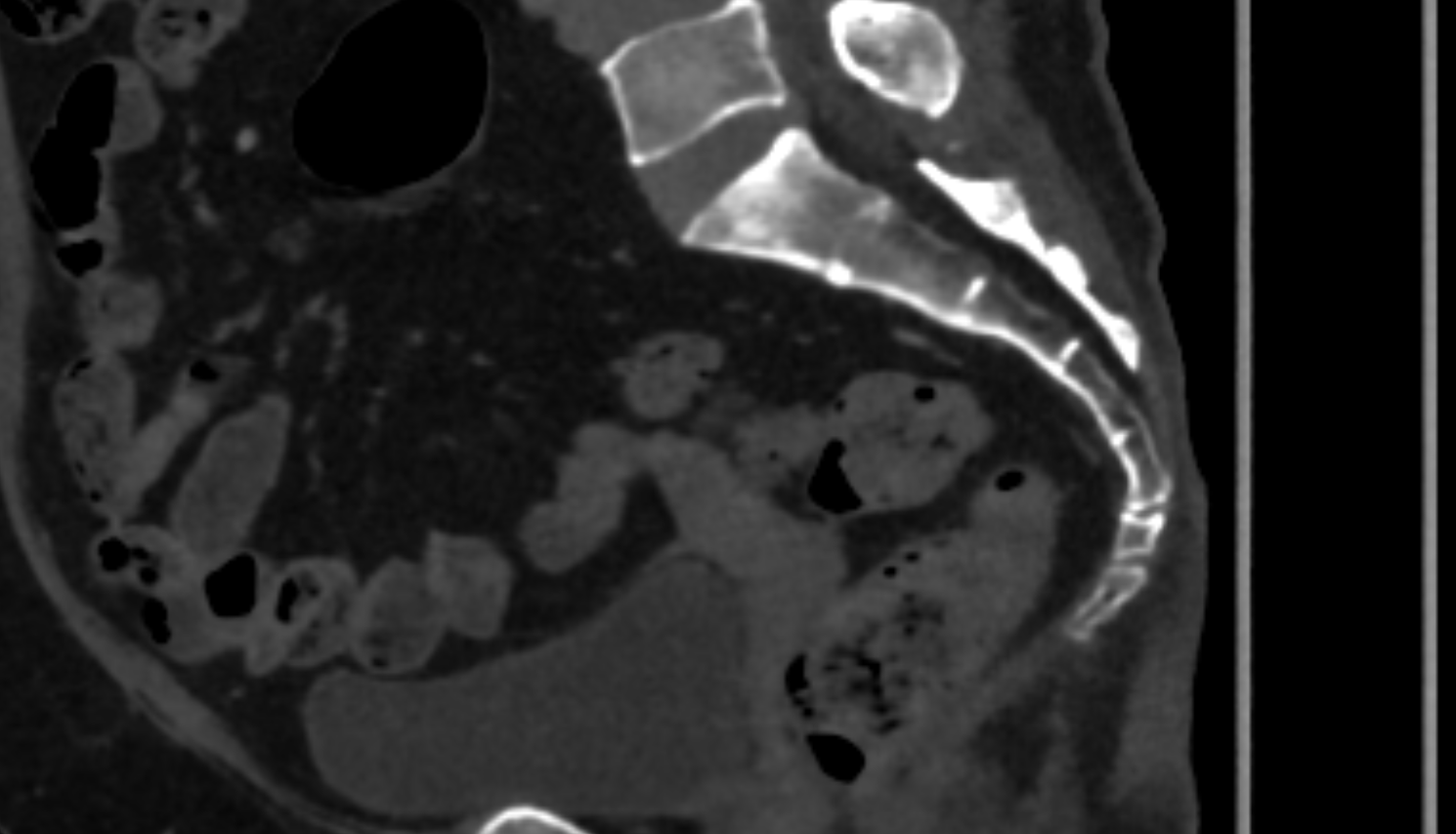 coccyx MRI SAG  anatomy  Location and Imaging Appearance  -img-00000-00000