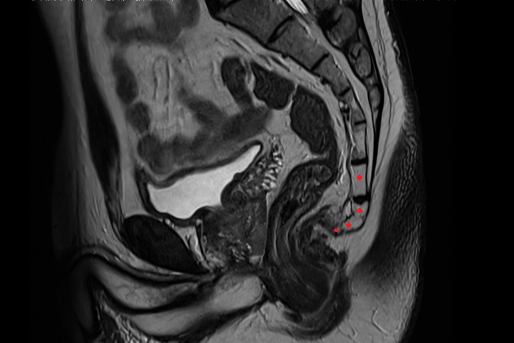 coccyx MRI SAG  anatomy  Location and Imaging Appearance  -img-00000-00000_00001