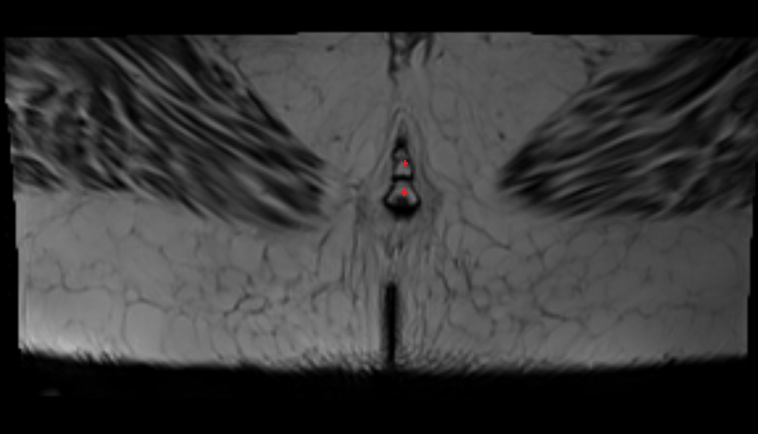 coccyx   MRI axial anatomy  image -img-00000-00000