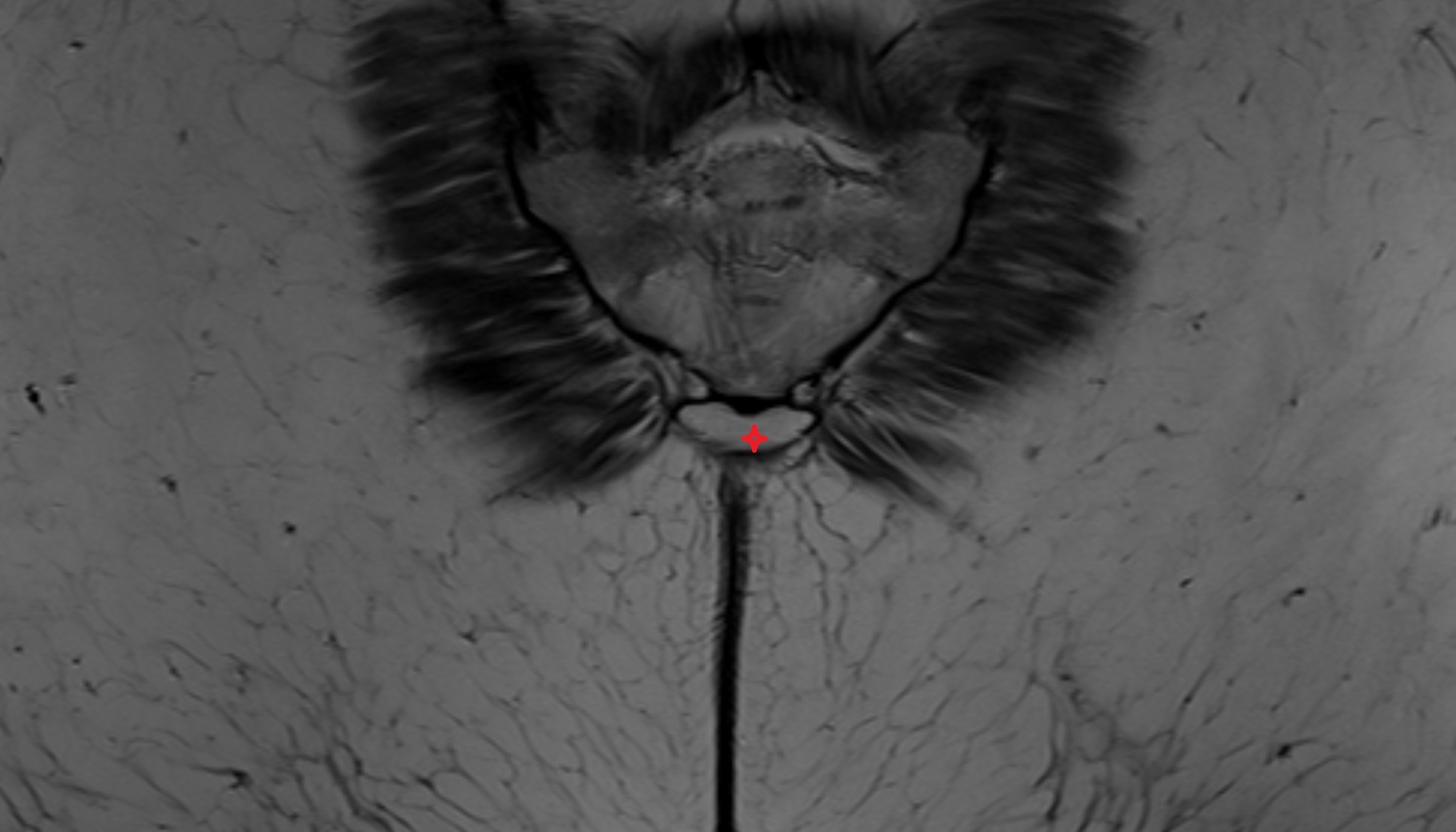 coccyx   MRI coronal anatomy  image -img-00000-00000