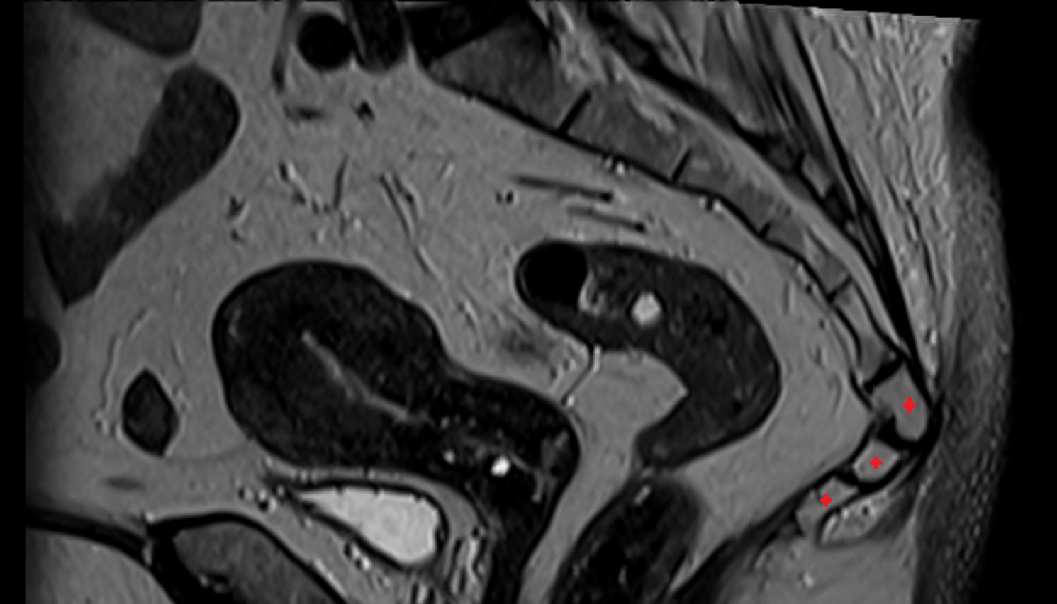 coccyx   MRI sag anatomy  image -img-00000-00000