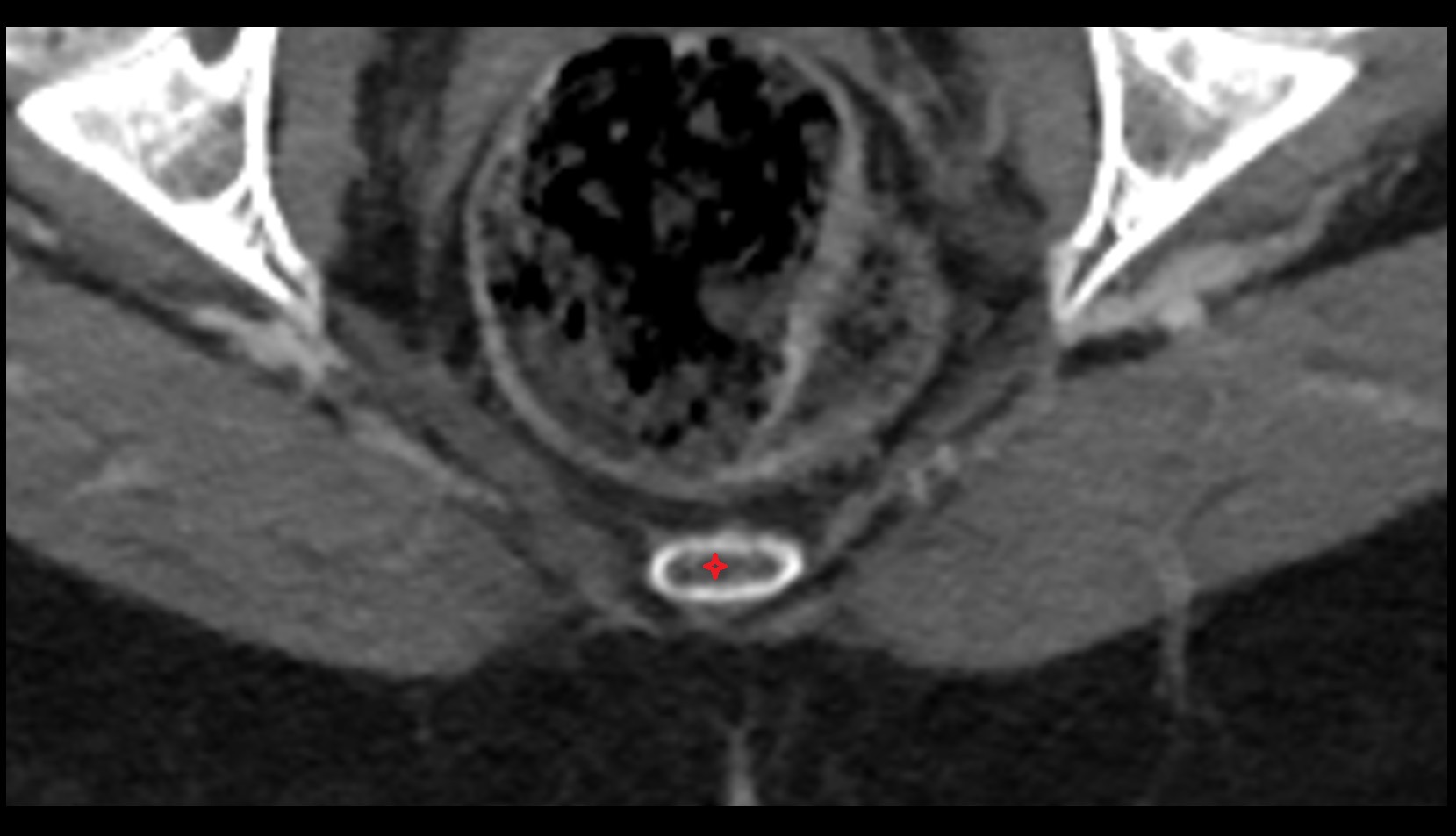 coccyx  axil ct image