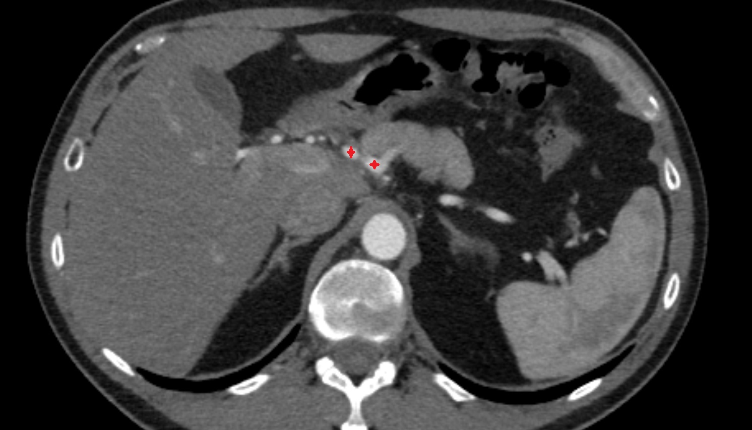 common hepatic artery anantomy  CT axial  image -img-00000-00000